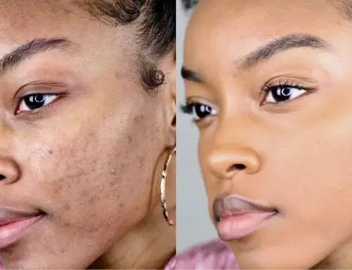 How to Hide Dark Spots on Your Face Without Makeup